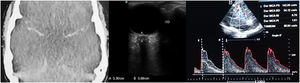 A 23-year-old male, following a traffic accident. A) Brain computed tomography scan upon admission (type III diffuse lesion); B) Measurement of ONSD=6.8mm; C) TCCD with high resistance pattern (PI=1,61). All the techniques performed suggest severe intracranial hypertension.
