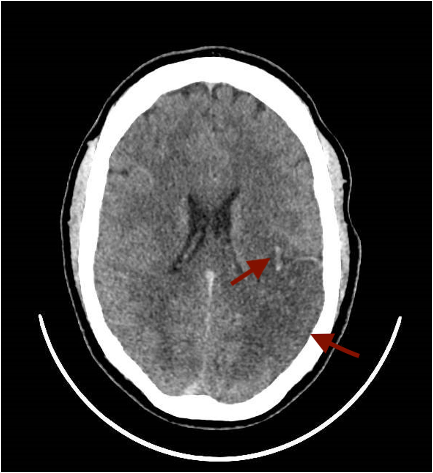 Vaccine induced Immune Thrombotic Thrombocytope Medicina Intensiva vaccine-induced-immune-thrombotic-thrombocytope-medicina-intensiva