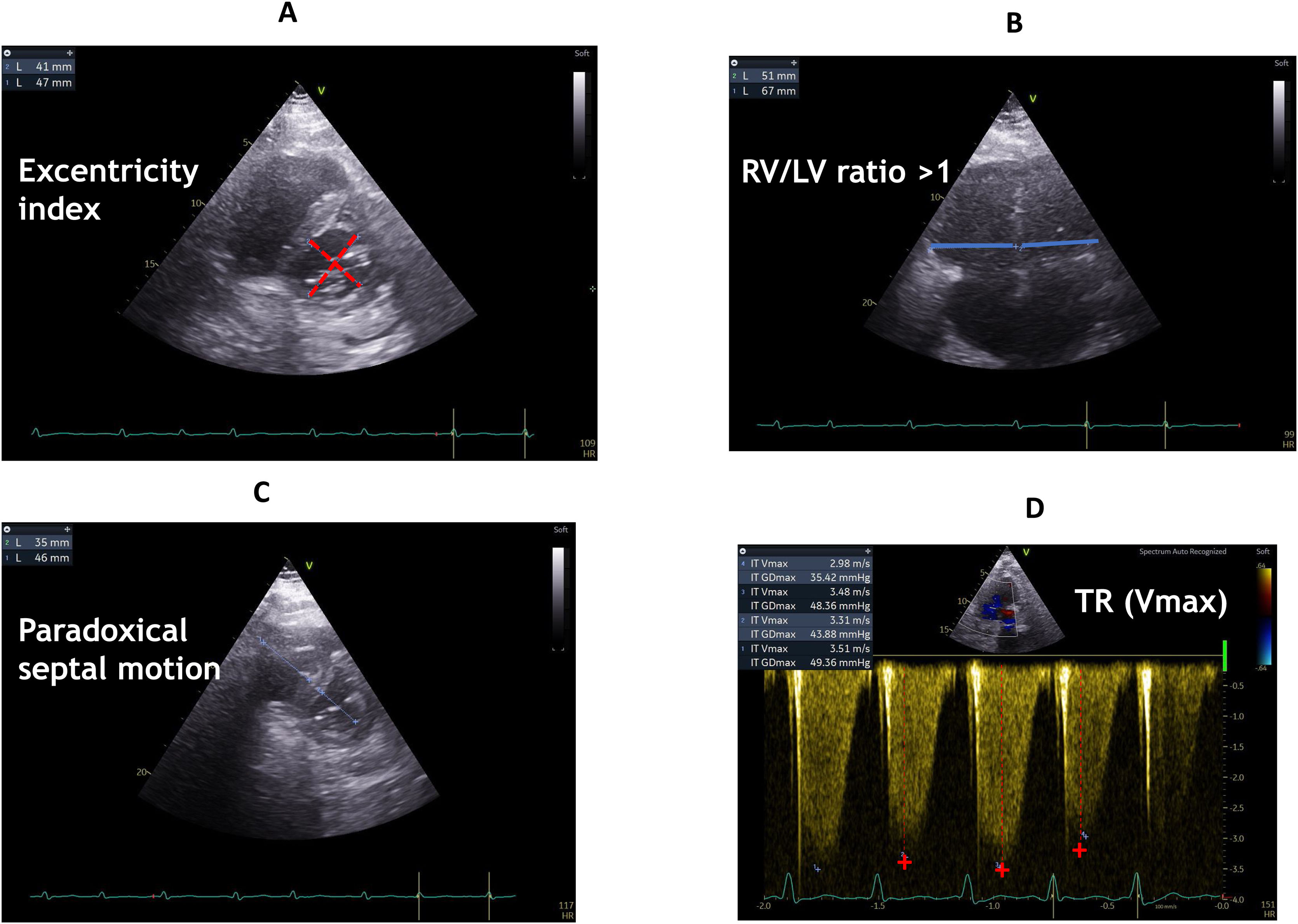 How to use echocardiography to manage patients with shock? | Medicina ...