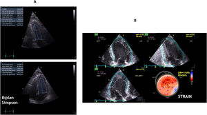Left ventricle function assessment: left ventricular ejection fraction calculated using Biplan Simpson method (A), and global longitudinal strain based on apical 4-, 2-,and 3-chamber view.