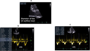 Measurement of the left ventricular outflow tract in parasternal long axis view (A), and velocity time integral (VTO) in left ventricle outflow tract in 5-chamber apical view using pulsed wave Doppler (B, C).