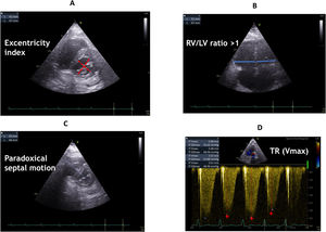 Indices of right ventricle dilation and/or pulmonary hypertension: parasternal short-axis view at the mid-ventricular level illustrating measurements of left ventricular diameters for calculation of the eccentricity index (A), and assessment of septal motion (C), right and left ventricle basal diameter ratio in apical 4-chamber view (B), peak velocity of tricuspid regurgitation (TR Vmax) obtained in apical 4-chamber view with continuous wave Doppler through tricuspid valve (D).