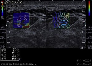 Elastography: cross-sectional view of the rectus femoris muscle in a 55-year-old patient with multiple organ failure showing kilopascal values that translate into muscle stiffness in various regions of interest (ROIs) (pink circles) at the bottom of the image. The presence of interfascial and intramuscular fluid becomes evidente here too.