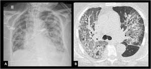 Images with bilateral infiltrates. A) CXR frontal view. B) Cross-sectional computed axial tomography.
