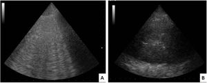 Lung ultrasound imaging. A) Abnormal interstitial ultrasound lung pattern: B-lines with tendency to coalescence. B) Consolidation image with air bronchogram (central hyperechogenic area).