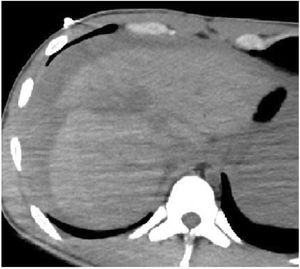 Abdominal CT scan without IV contrast. Hepatic lacerations compromising the entire thickness of the liver up to the inferior vena cava. Extensive hemoperitoneum resulting from intrahepatic vessel injury.