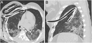 Thoracic CT scan without IV contrast with a lung window. A. Right chest tube with an intraparenchymal trajectory. B. Kinked left chest tube within the fissure.