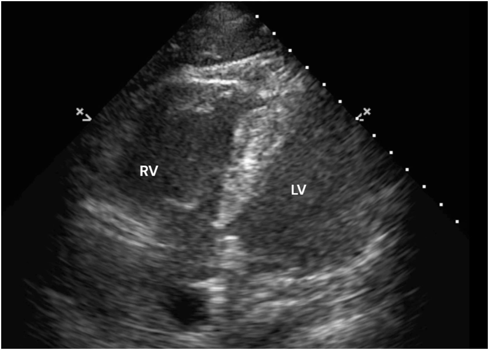 McConnell’s sign in fat embolism syndrome | Medicina Intensiva