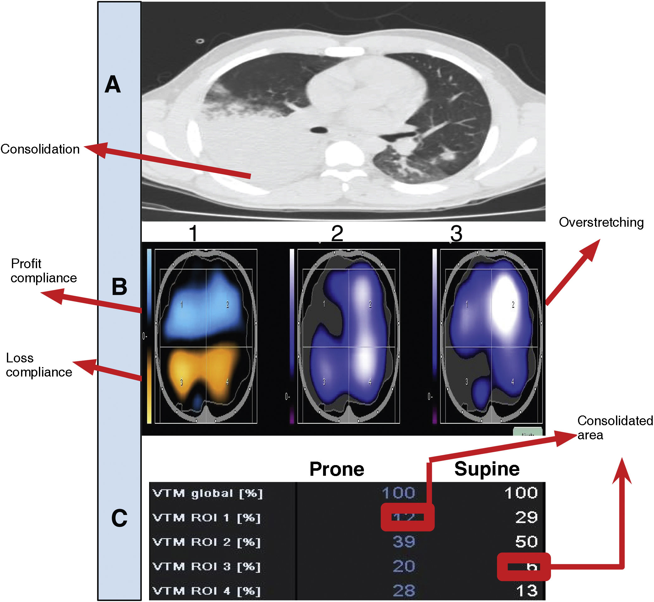 Evaluation of the response to the prone position through electrical ...