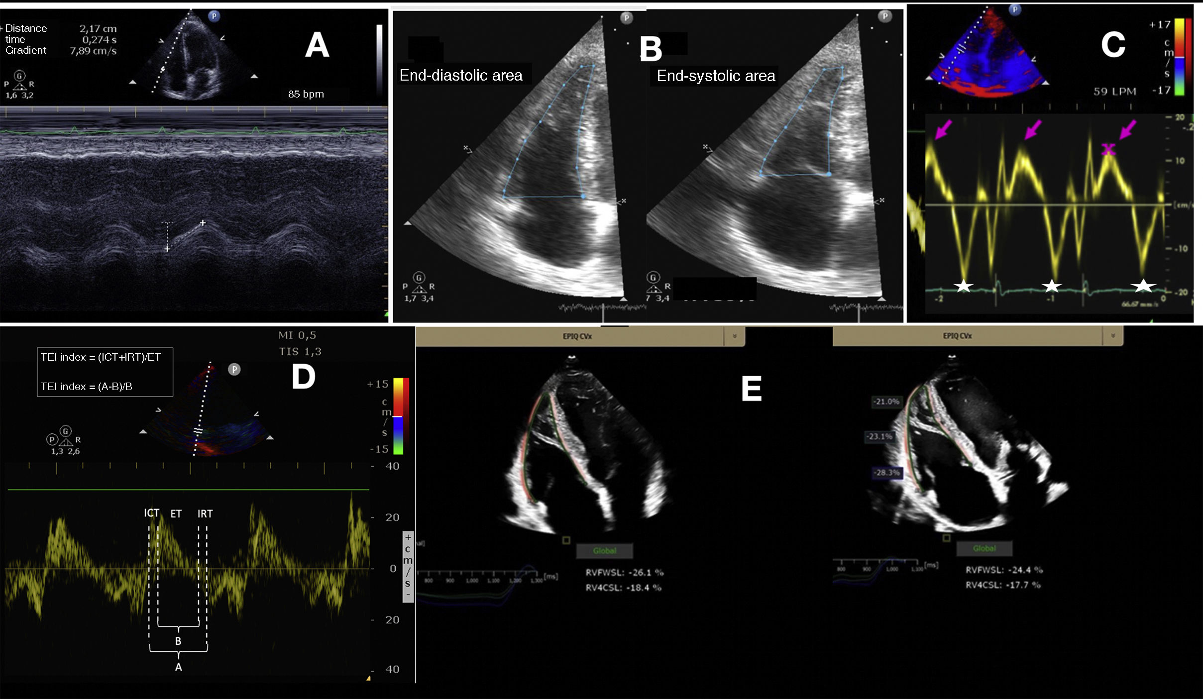 Right ventricular dysfunction in the critically ill. Echocardiographic ...