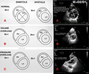 Ventricular interdependence. RV: right ventricle; LV: left ventricle; EI: eccentricity index; A: normal eccentricity pattern of the LV; B: volume overload with flattening of the septum only in diastole; C: pressure overload with flattening of the septum in systole and diastole; D2: anteroposterior diameter of the LV; D1: septo-lateral diameter of the LV.
