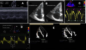 A. TAPSE. B. FAC. C. Tissue Doppler. The arrow indicates the systolic wave and the star indicates the velocity of the e wave. D. TEI index: measures the ratio between the isovolumetric contraction and relaxation times in relation to systolic ejection. It can be quantified with pulsed Doppler or from the tissue Doppler registry. The advantage of tissue Doppler is that it can record all the information of the cardiac cycle in the same beat, and improves the reproducibility of the technique. Measurement is made of the isovolumetric contraction time (ICT), the isovolumetric relaxation time (IRT) and the ejection time (ET) in the pulsed tissue Doppler spectrum of the lateral tricuspid annulus. E. Strain.