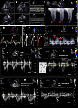 A. Variation of the inferior vena cava. The 2D inspiration and expiration image is shown in M mode. B. Continuous Doppler recording of tricuspid insufficiency. The red arrow indicates tricuspid insufficiency maximum velocity. C. Isovolumetric relaxation time (IRT). D. Pulmonary artery acceleration time (Tac). E. Pulsed Doppler recording of pulmonary insufficiency. The arrows indicate the protodiastolic maximum velocity of the pulmonary insufficiency flow (VPIed) and the end-diastolic maximum velocity of the pulmonary insufficiency flow (VPIed). F. Normal type I pulmonary artery flow with symmetrical ascent and descent. G. Type I pulmonary artery flow with symmetrical triangular follow, normal flow. H. Type II pulmonary artery flow with asymmetrical triangular follow, suggestive of increased pulmonary pressure. I. Type III pulmonary artery flow with an arrow indicating the mesosystolic notch due to early closure of the pulmonary valve.