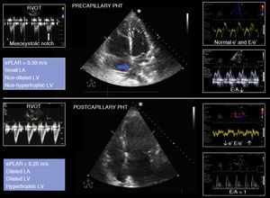 Echocardiographic signs suggestive of pre- and postcapillary pulmonary hypertension. The blue arrow indicates the interatrial septum bulging towards the left atrium. LA: left atrium; ePLAR: echographic pulmonary to left atrial ratio = [VmaxTI/(E/eʹ) mitral]; PHT: pulmonary hypertension; RVOT: right ventricle outflow tract; LV: left ventricle.