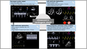 Usefulness of echocardiography in cardiogenic shock. Calculation of cardiac output based on the formula: systolic volume = area of the left ventricle outflow tract x velocity-time integral of the left ventricle outflow tract. Evaluation of left and right ventricular function, and analysis of filling pressures and pulmonary artery pressure based on pulsed doppler recording of transmitral flow in relation to tissue doppler mitral ring study.