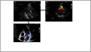 Complications associated to acute coronary syndrome that can lead to cardiogenic shock. A and B: septal rupture with interventricular communication. C: ischemic mitral valve insufficiency.
