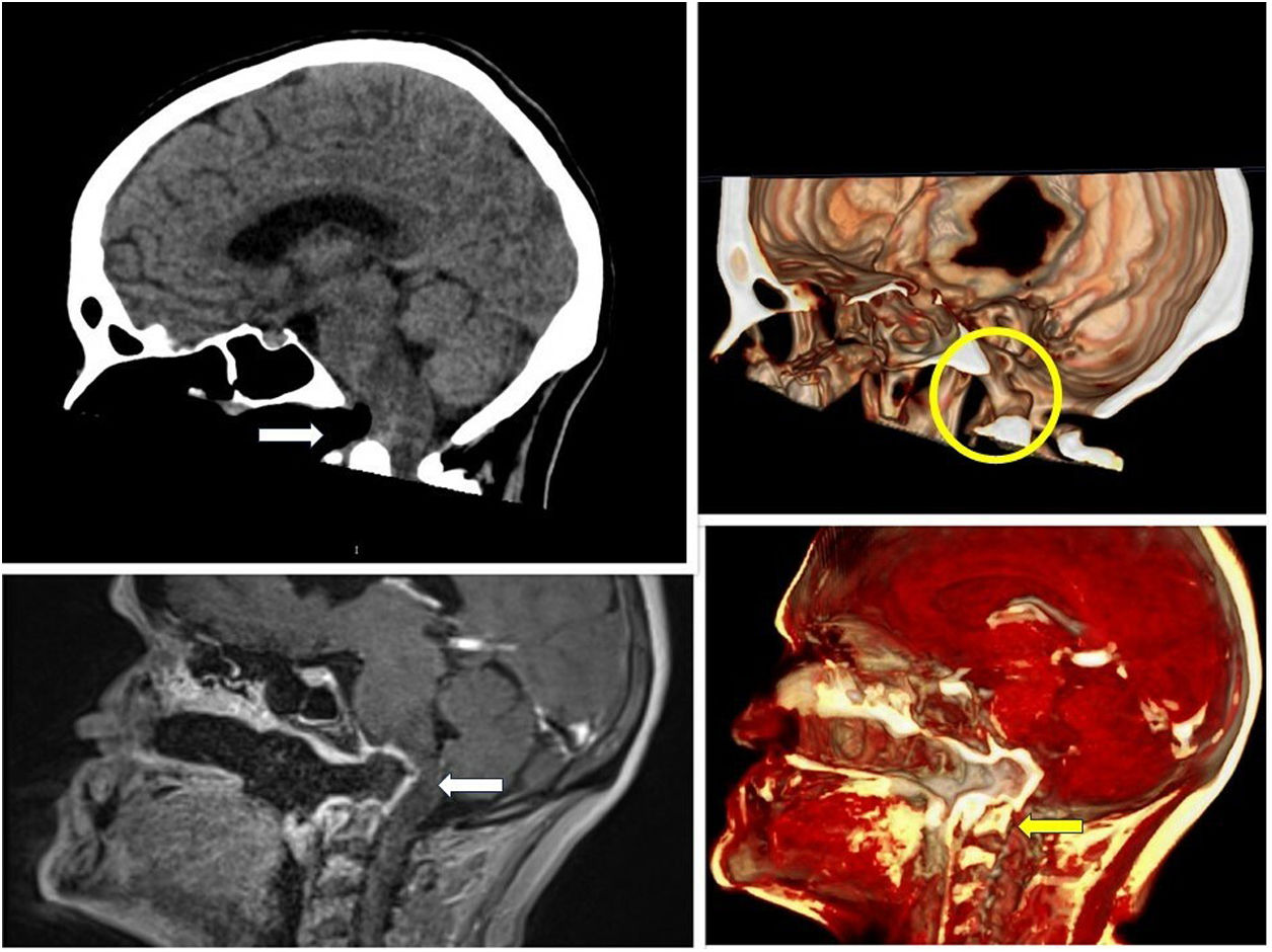 Perforation of the skull base due to cocaine | Medicina Intensiva