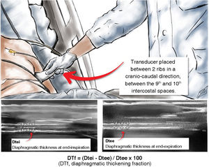 Measurement of diaphragm thickening fraction.