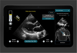 Two-plane views of a study made with the help and guidance of Caption AI© and Caption Guidance©. Different aid items are available that guide the transducer until an optimum plane is recognized and obtained (including even classification of the degree of optimization achieved). The best loop is automatically recorded, and the measures that can be obtained from it are displayed.