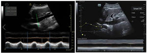Automatic definition of the margins of the inferior vena cava (IVC) using Venue GE© and Smart Fluid Mindray© from the subcostal plane, with continuous monitoring: the green color contour does not appear until the plane is optimized, and on freezing the image, automatic calculations are made of the maximum and minimum diameters in order to apply the IVC collapsibility formula.