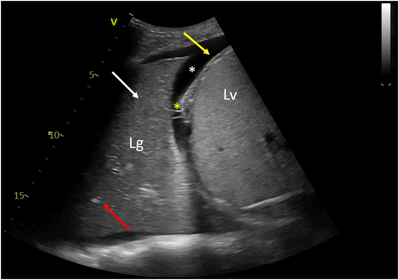 Dynamic air bronchogram in pneumococcal community acquired pneumonia ...