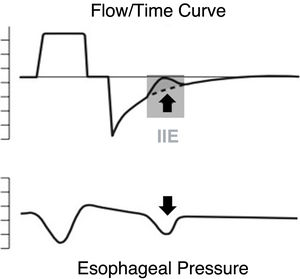 Graphical representation of an ineffective inspiratory effort.