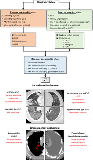 Diagnostic algorithm for patients treated with ICI who develop respiratory failure. CS: corticosteroids. CTX: chemotherapy. ECG: electrocardiogram. cMRI: cardiac magnetic resonance. CMV: cytomegalovirus. TBC: tuberculosis. PCP: pneumocystis pneumonia. 1Primary lung neoplasms carry a higher risk for both infections and immunotherapy related pneumonitis. 2Pulmonary tuberculosis has a higher incidence in patients treated with anti PD1 agents (nivolumab and pembrolizumab).