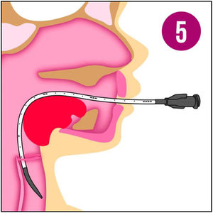 Performing the LISA technique with Surfcath®21 catheter, currently used in our unit.