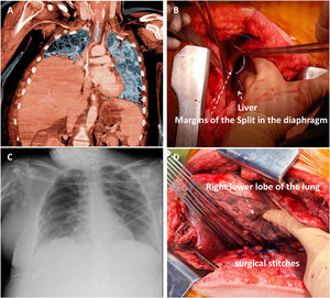 (A) A preoperative computed tomography (coronal slice) scan of the chest and upper abdomen confirmed a right hemidiaphragmatic hernia, showing a liver in the right chest. (B) Image during repair surgery. A wide diaphragmatic defect showed protrusion of the liver through it. (C) Postoperative chest radiograph after surgical repair. (D) The surgical suture appreciated the width of the diaphragmatic tear.