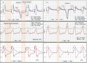 Traces of airway pressure (Paw), tracheal pressure (Ptra), oesophageal pressure (Pes), gastric pressure (Pgas), transdiaphragmatic pressure (Pdi), flow, and volume. Panel A, before surgery. During the expiratory occlusion manoeuvre, Paw and Ptra signals showed inability to maintain the PEEP set, as indicated by the descending step image, as the thorax and abdomen fused into a single compartment due to the diaphragmatic defect. Biphasic Pgas due to unilateral diaphragmatic injury and reduced Pdi. Note that Pes reflects the cyclic changes of Pgas—including expiratory muscle activation—and shares the same basal pressurization. Panel B, after the plication of the injured right diaphragm. The normalization of the signal during occlusion can be seen, as can the relationship between Pgas and Pes during inspiratory effort. Ers, Elastance respiratory system. Rrs, Total resistances respiratory system.