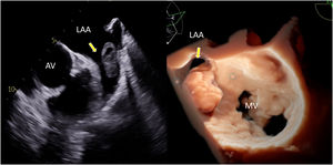TOE in 2D at 60° (left) and in 3D TrueVue en-face view showing the LAA occupied by a massive echogenic mass compatible with thrombus. AV: aortic valve; MV: mitral valve; LAA: left atrial appendage.