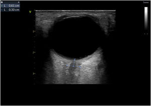 Measurement of the diameter of the optic nerve sheath to rule out significant intracranial hypertension. The patient had a ONSD of 6.1 mm and ICP 25 mmHg at the time the examination was performed.
