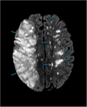 Diffusion MRI sequence showing bilateral acute-subacute cerebral infarcts.