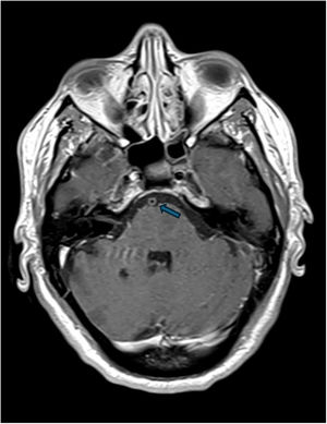 MRI with contrast injection: enhancement and concentric thickening of the basilar artery wall.