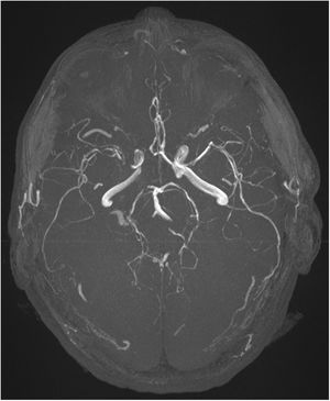 Angio-MRI reconstruction showing multiple vascular strictures.