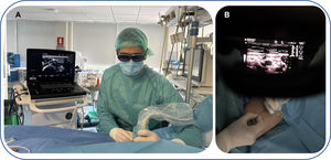 Ultrasound-guided vascular cannulation procedure with augmented reality glasses (smart glasses). (A) Subjective operator view through the smart glasses while cannulating the venous access. (B) The ultrasound image is projected in the upper part of the operator