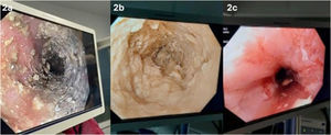Endoscopy view. (a and b) endoscopic image of the bezoar, (c) Image after endoscopic disimpaction of the bezoar.