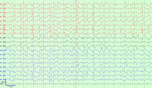 Capture of the patient’s recording in super-refractory status, shown in “point of view” before isoflurane administration. At the time this recording was obtained, the patient was being treated with lacosamide, levetiracetam, valproic acid, and propofol. Waves interpretarion is provided in the text.