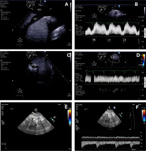 VExUS protocol by TEE. IVC: inferior vena cava; HV: suprahepatic vein; PV: portal vein.