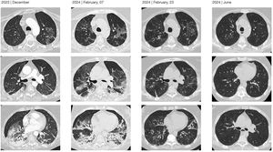 Radiological evolution in high-resolution chest computed tomography studies.