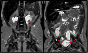 Abdominal magnetic resonance: Bladder with two filling defects suggestive of bilateral ureteroceles.1 Left vesicoureteral reflux, reaching the upper urinary tract with mild dilation.2