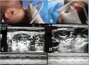 Scalenus anterior thickening. A-probe position for right side examination, B-probe position for left side examination. C-ultrasound view of right scalenus anterior, D-ultrasound view of left scalenus anterior. 1-sternomastoid muscle, 2-anterior scalene muscle, 3-middle scalene muscle. 4-brachial plexus, 5-inspiratory thickness, 6-expiratory thickness.