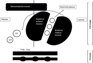 Illustrative diagram for the scalene muscle ultrasound. CA: carotid artery, Exp: expiration, IJV: internal jugular vein, Ins: inspiration.