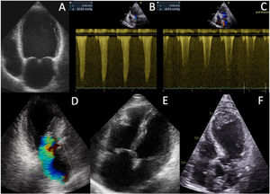 Cardiogenic shock phenotypes in Takotsubo syndrome. Pure pump failure secondary to acute-onset left ventricular dysfunction (Panel A). Left ventricular outflow tract obstruction (Panel B) and its improvement flowing phenylephrine administration (Panel C). Mitral regurgitation secondary to systolic anterior movement of the anterior mitral leaflet (Panel D). Right ventricular dilatation secondary to acute right ventricular failure (Panel E). Other mechanisms of shock and hemodynamic collapse include bradyarrhythmias and tachyarrhythmias, and mechanical complications, such as free wall rupture and ventricular septal defect. A notable complication in some cases of severely depressed contractile function is the formation of intraventricular thrombus, likely due to stagnant flow within akinetic or dyskinetic ventricular segments, increasing the risk of embolic events (Panel F).