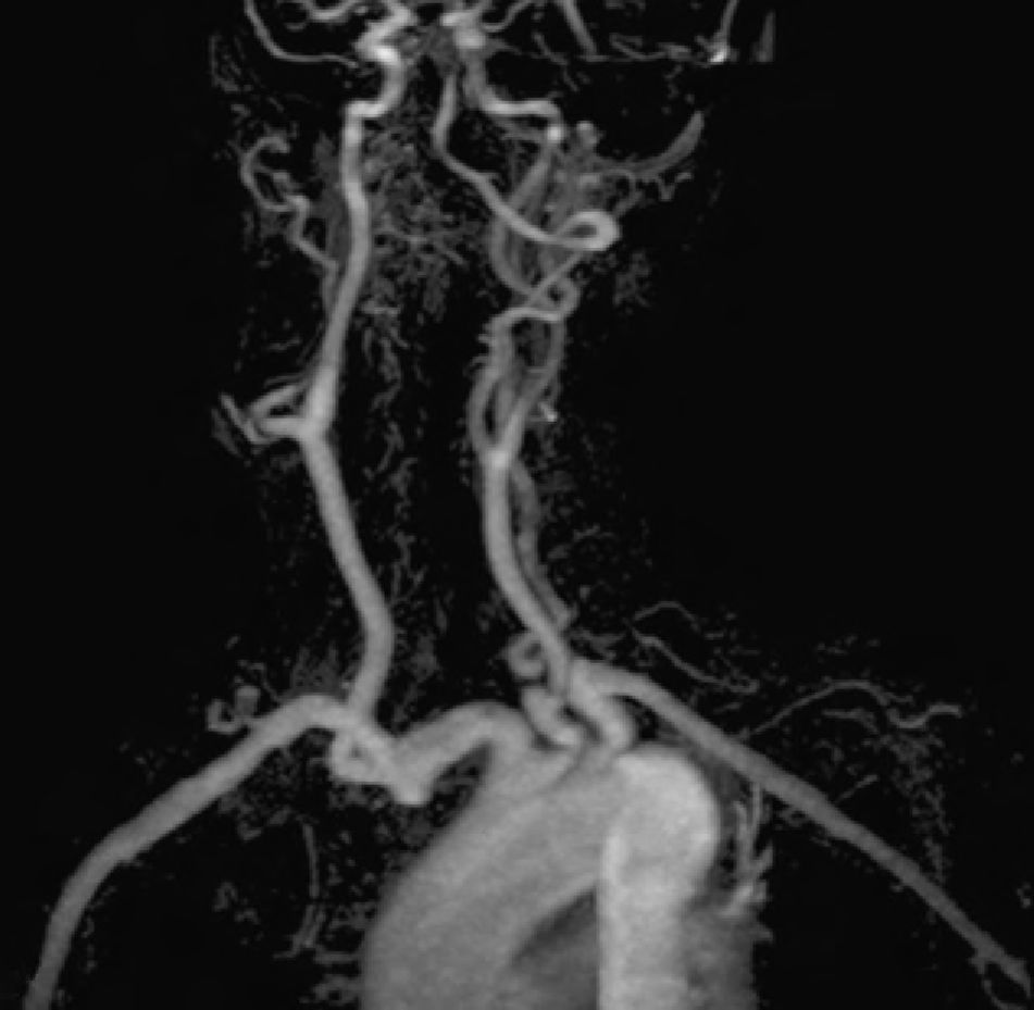 High Riding Innomate Artery High-Riding Innominate Artery in Neck Surgery | Acta ...