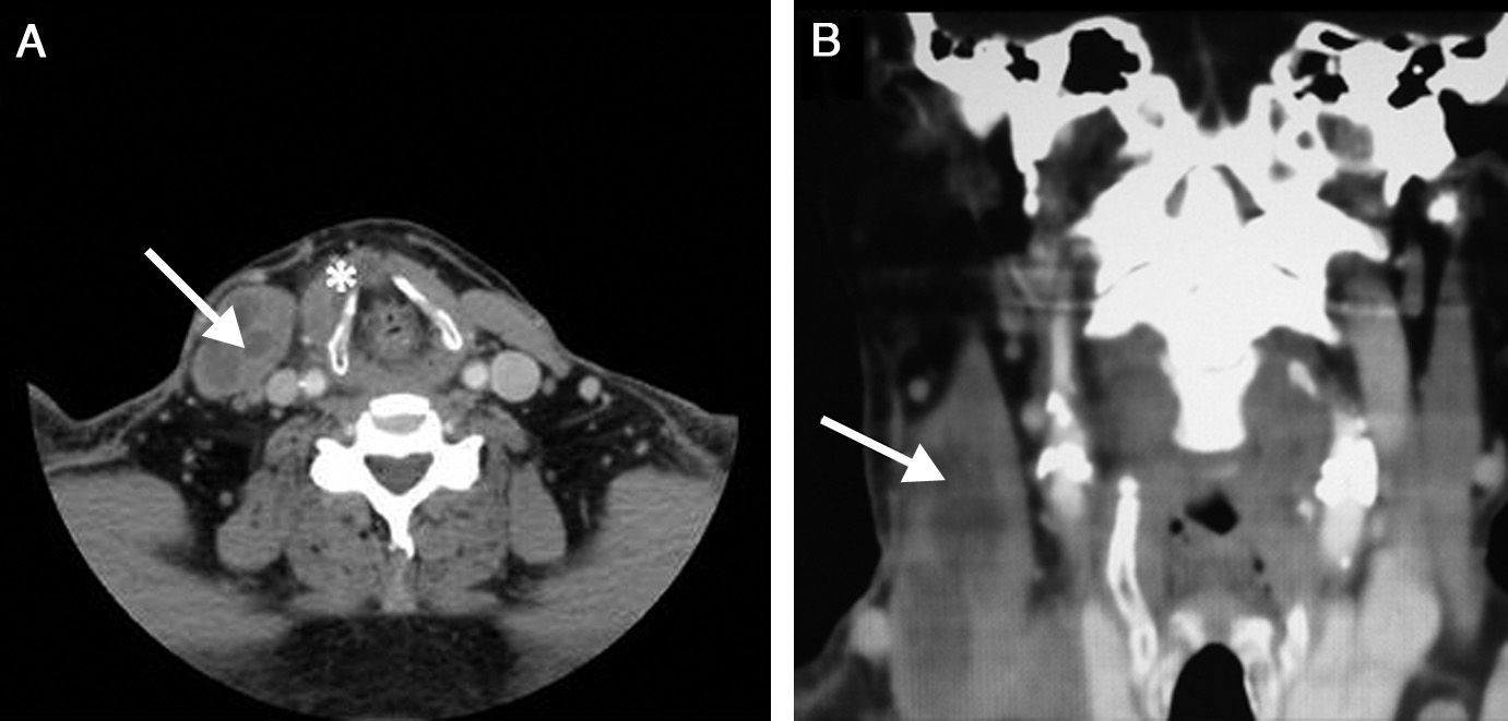 Pyomyositis Ct Sternocleidomastoid Pyomyositis in an Immunocompetent Patient | Acta ...