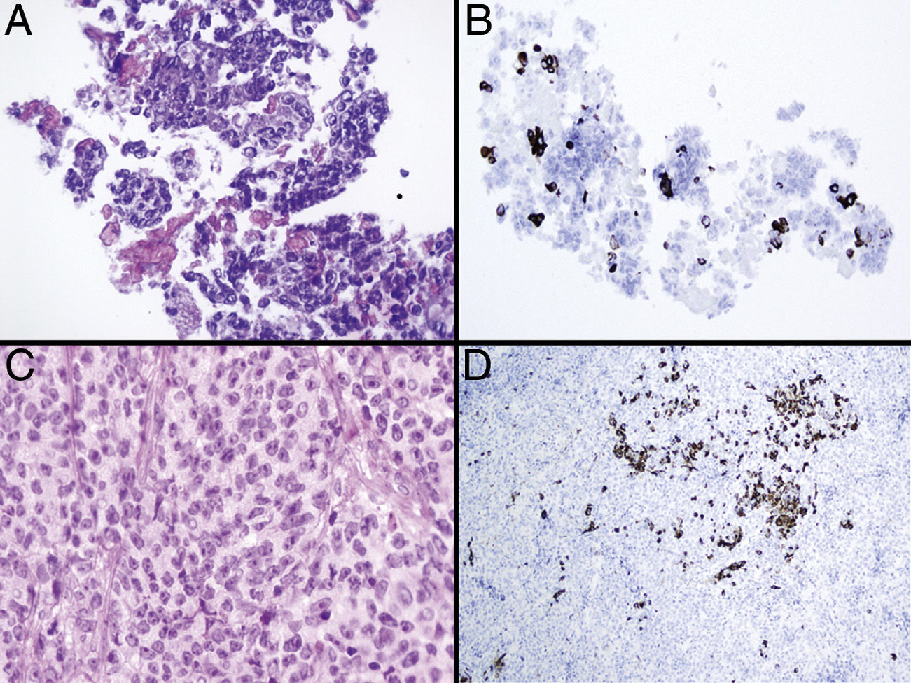 Thyroid Nodule as a First Sign of Progression in Uterine Cervical ...