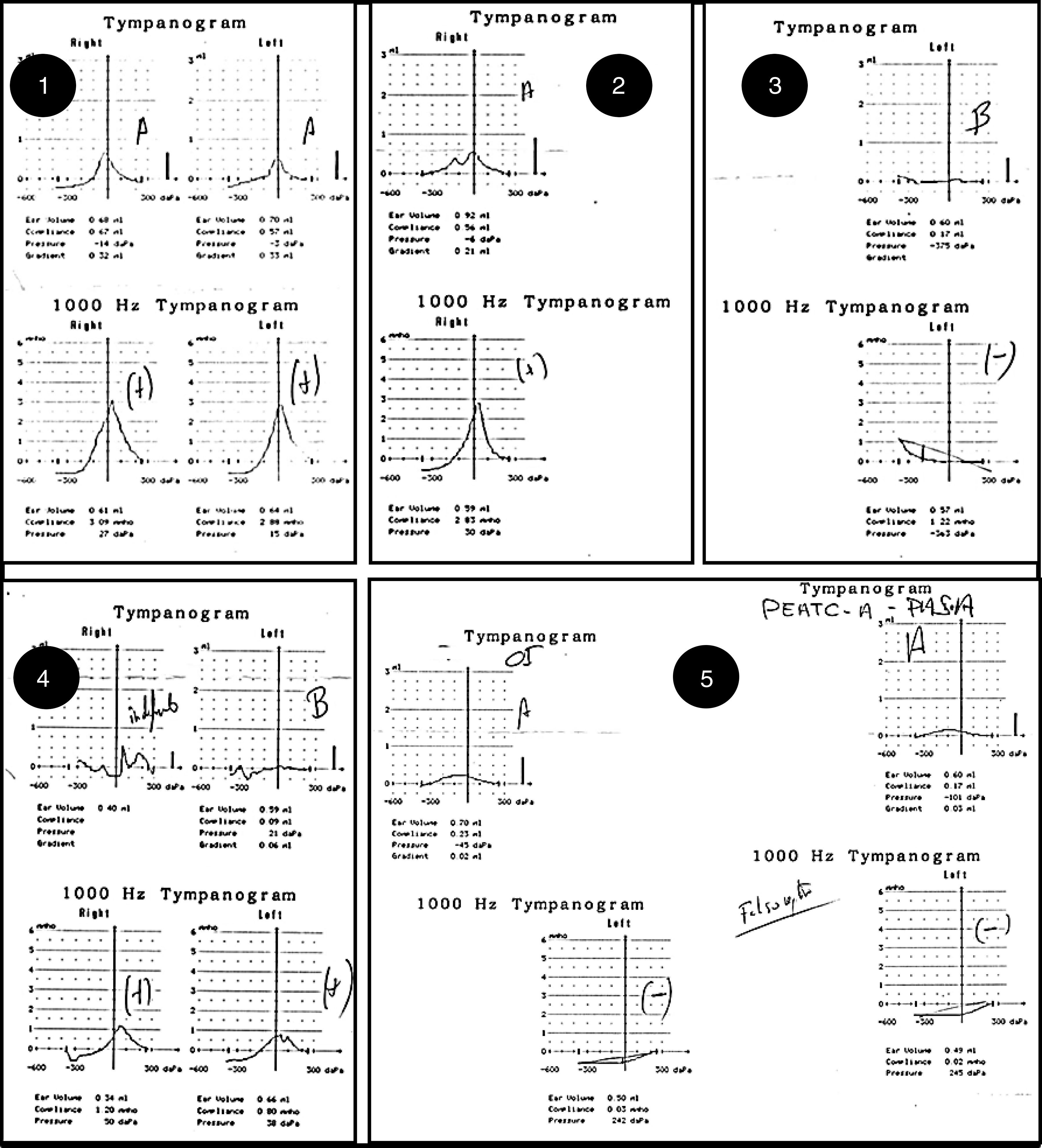 High Frequency Tympanometry (1000Hz) in Young Infants and Its