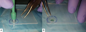 (A) and (B) In-house silicone collar design with an external diameter of 3cm and internal diameter of 6mm. It enables good adjustment around the prosthesis.