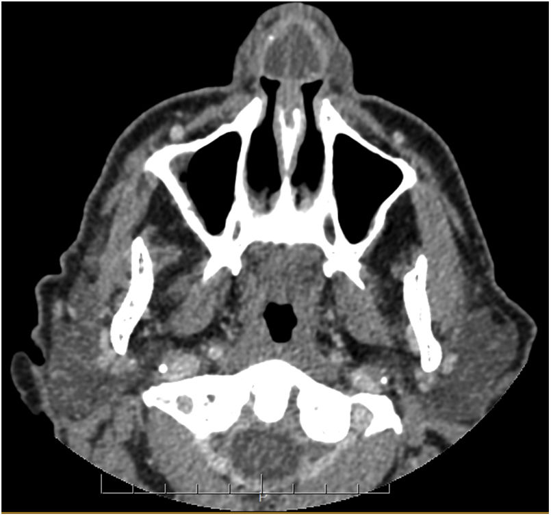 Spontaneous Septal Abscess as the Cause of Septic Shock | Acta ...